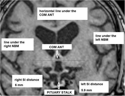 Metric magnetic resonance imaging analysis reveals pronounced substantia-innominata atrophy in dementia with Lewy bodies with a psychiatric onset